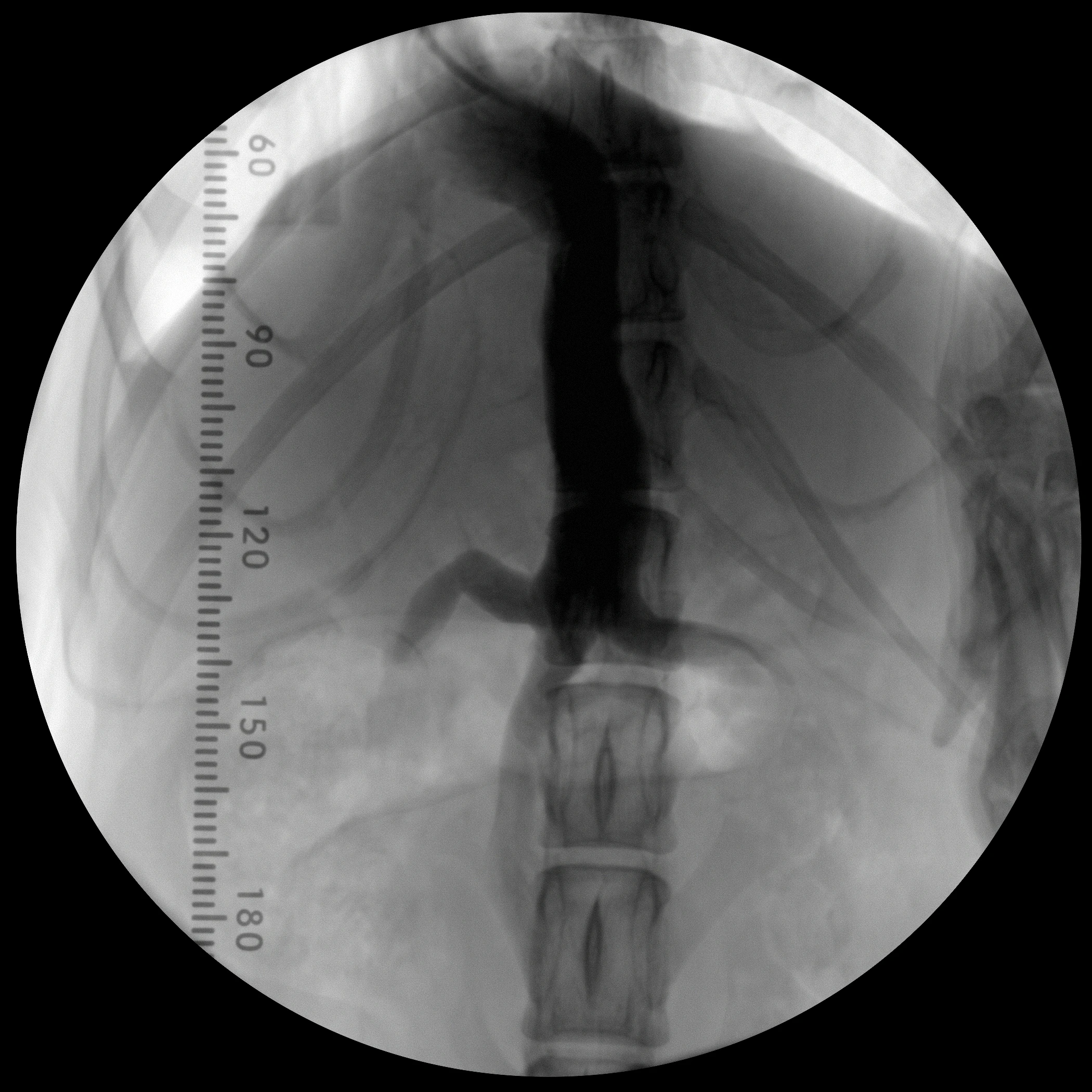 Fluoroscopic swallow study