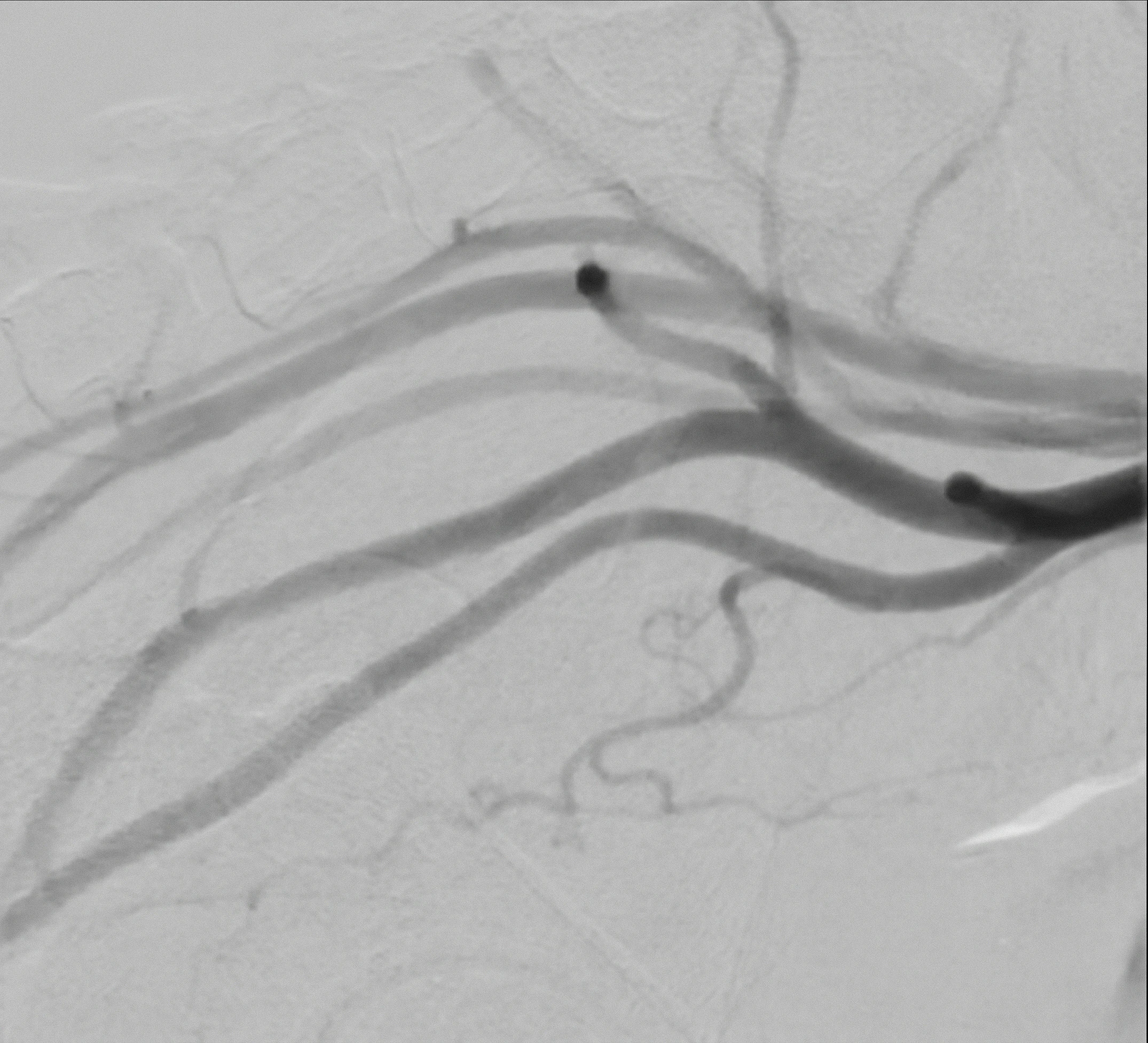 Angiogram during interventional radiology procedure