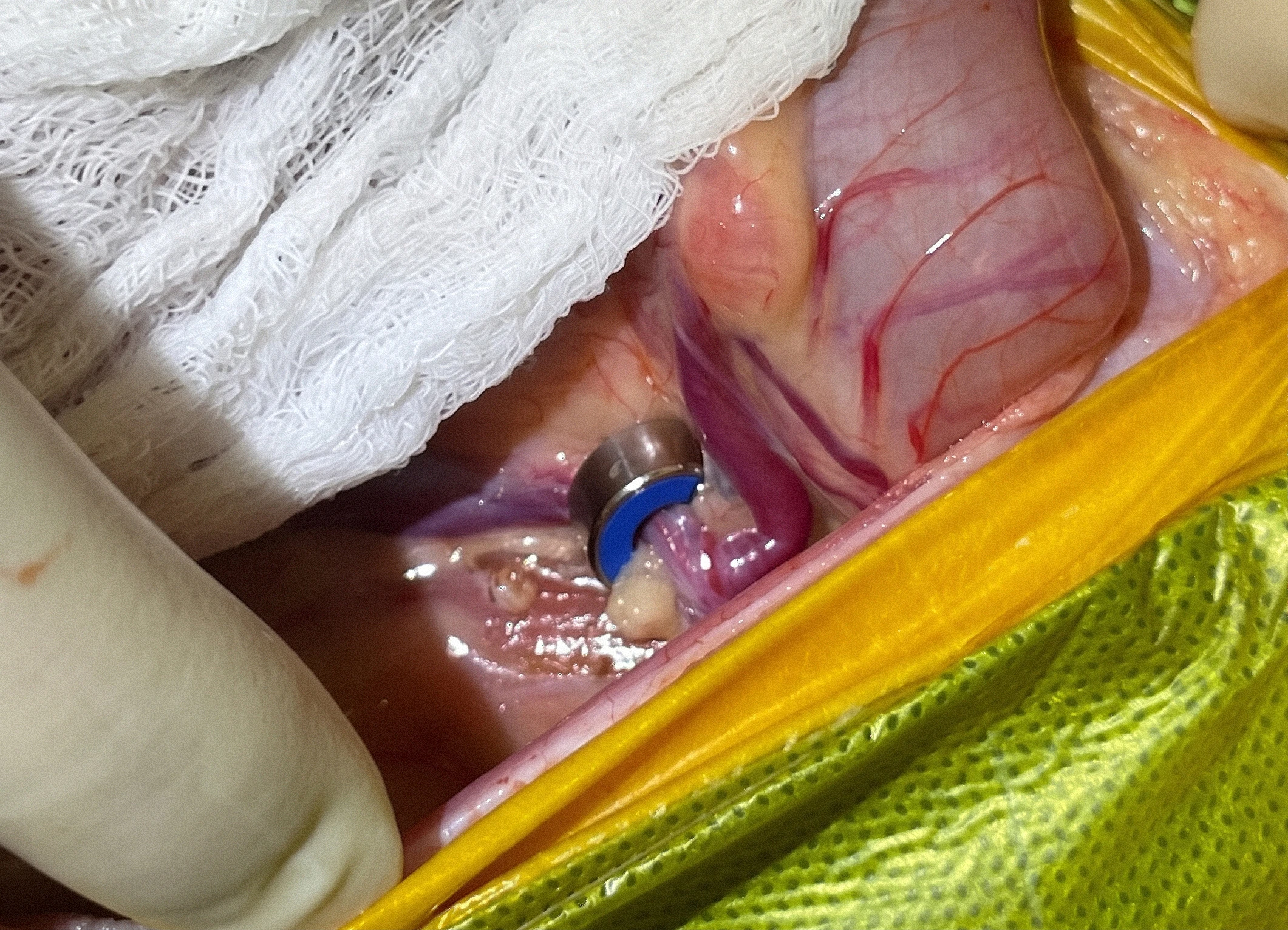 Subcutaneous ureteral bypass surgery