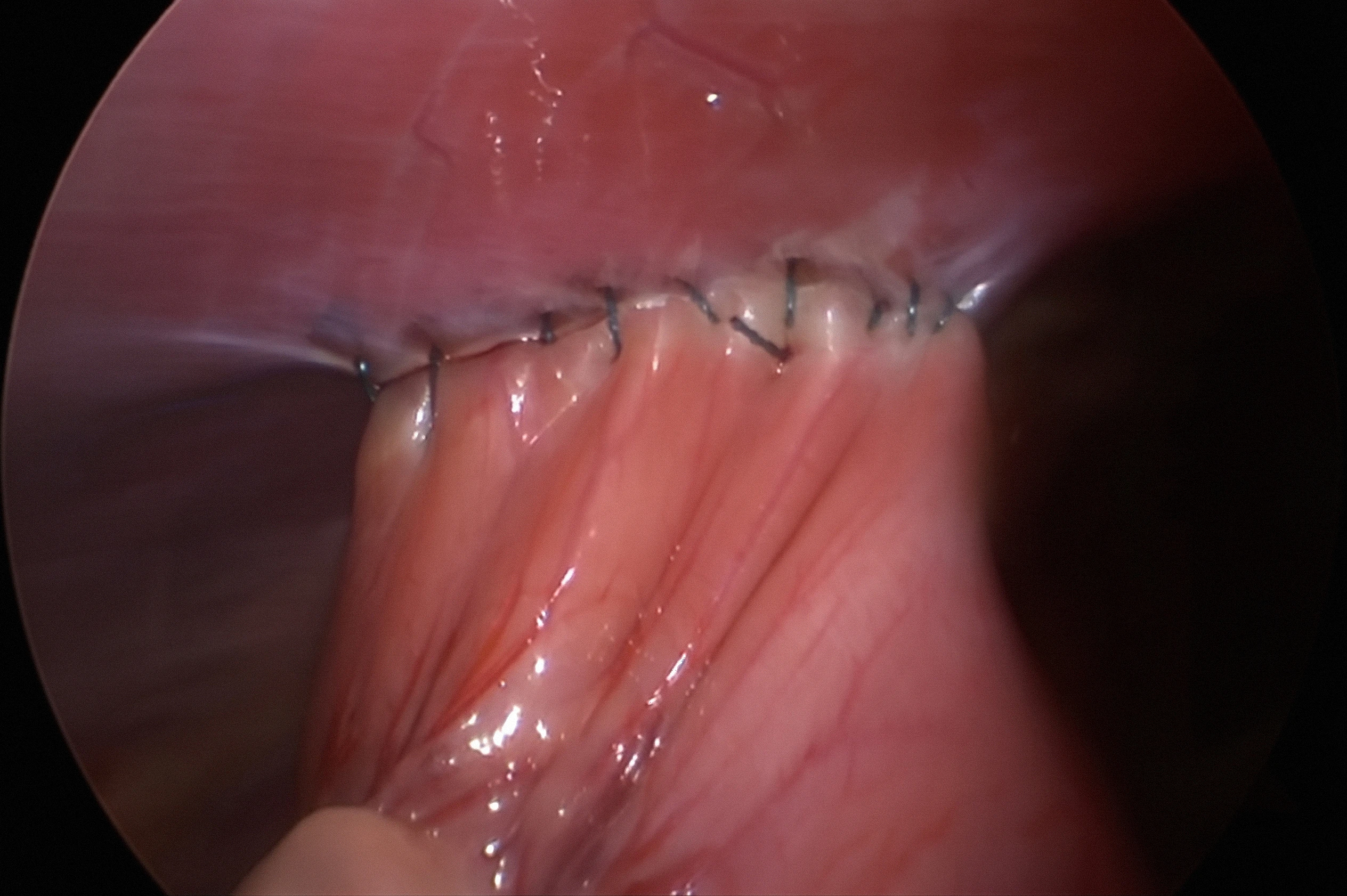 Laparoscopic gastropexy
