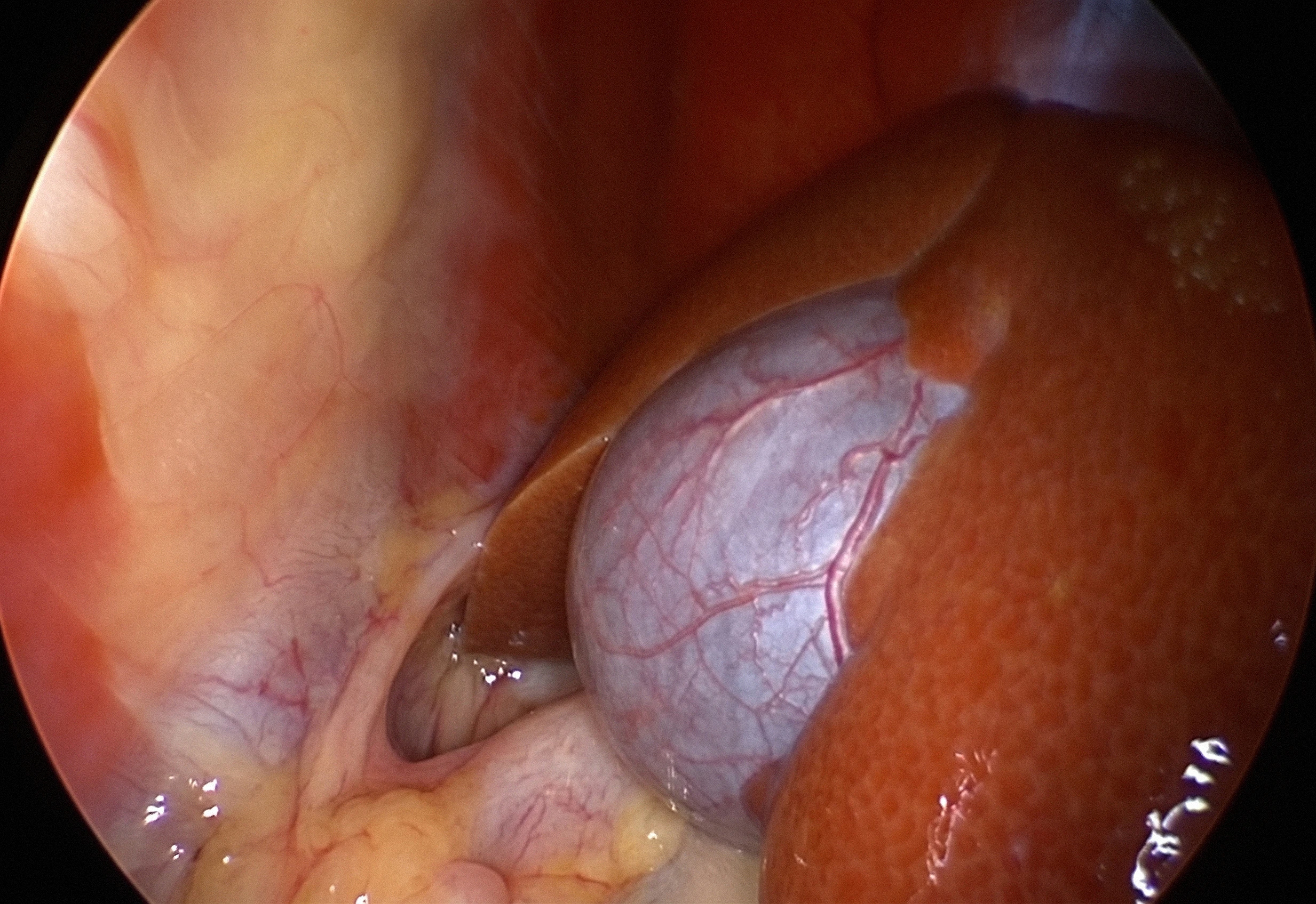 Laparoscopic gallbladder removal