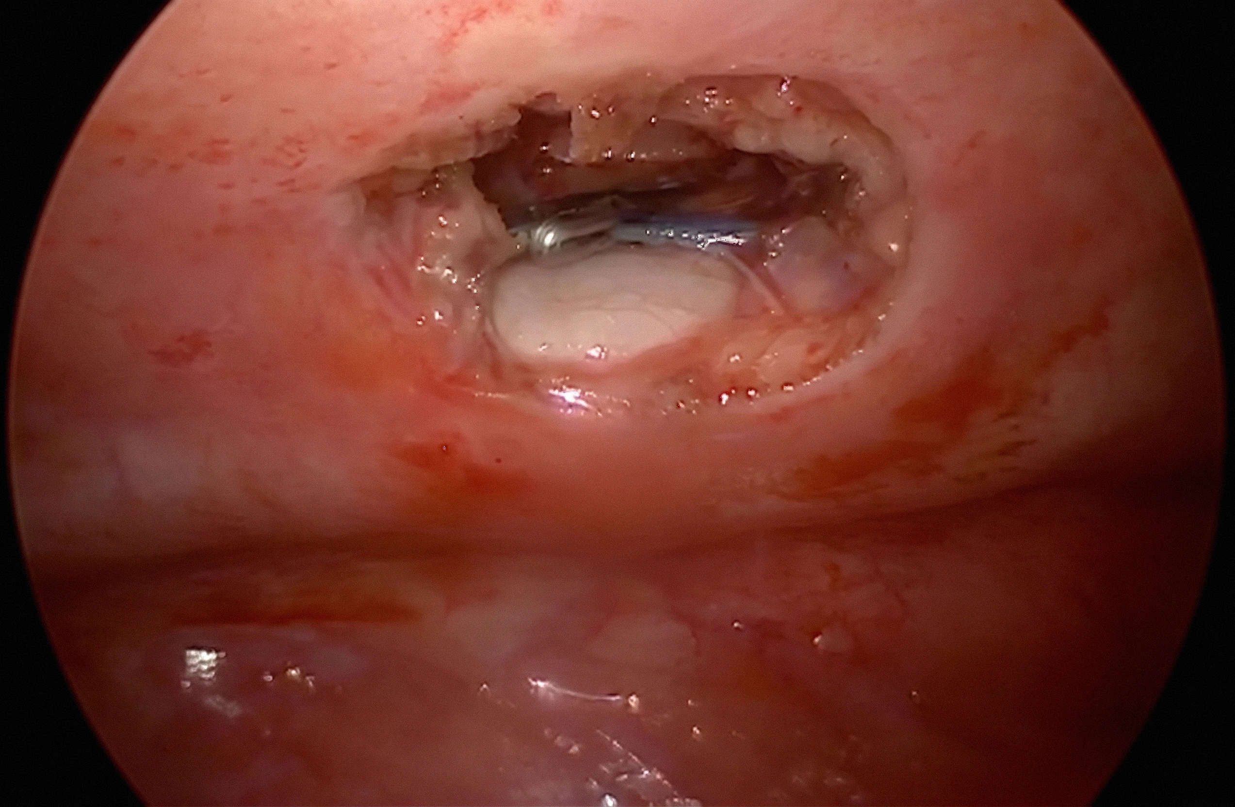 Thoracoscopy minimally invasive chest surgery