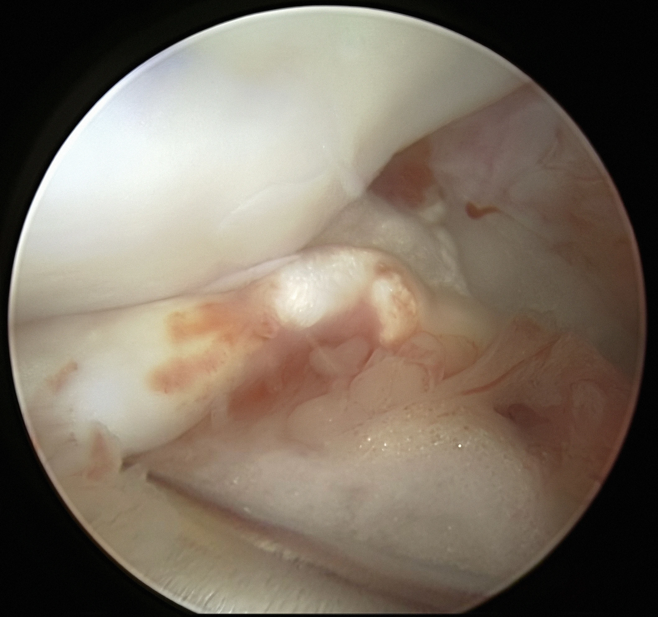 Arthroscopy procedure