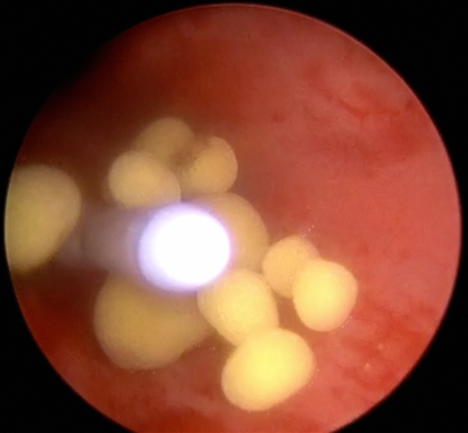 Bladder stones seen during cystoscopy